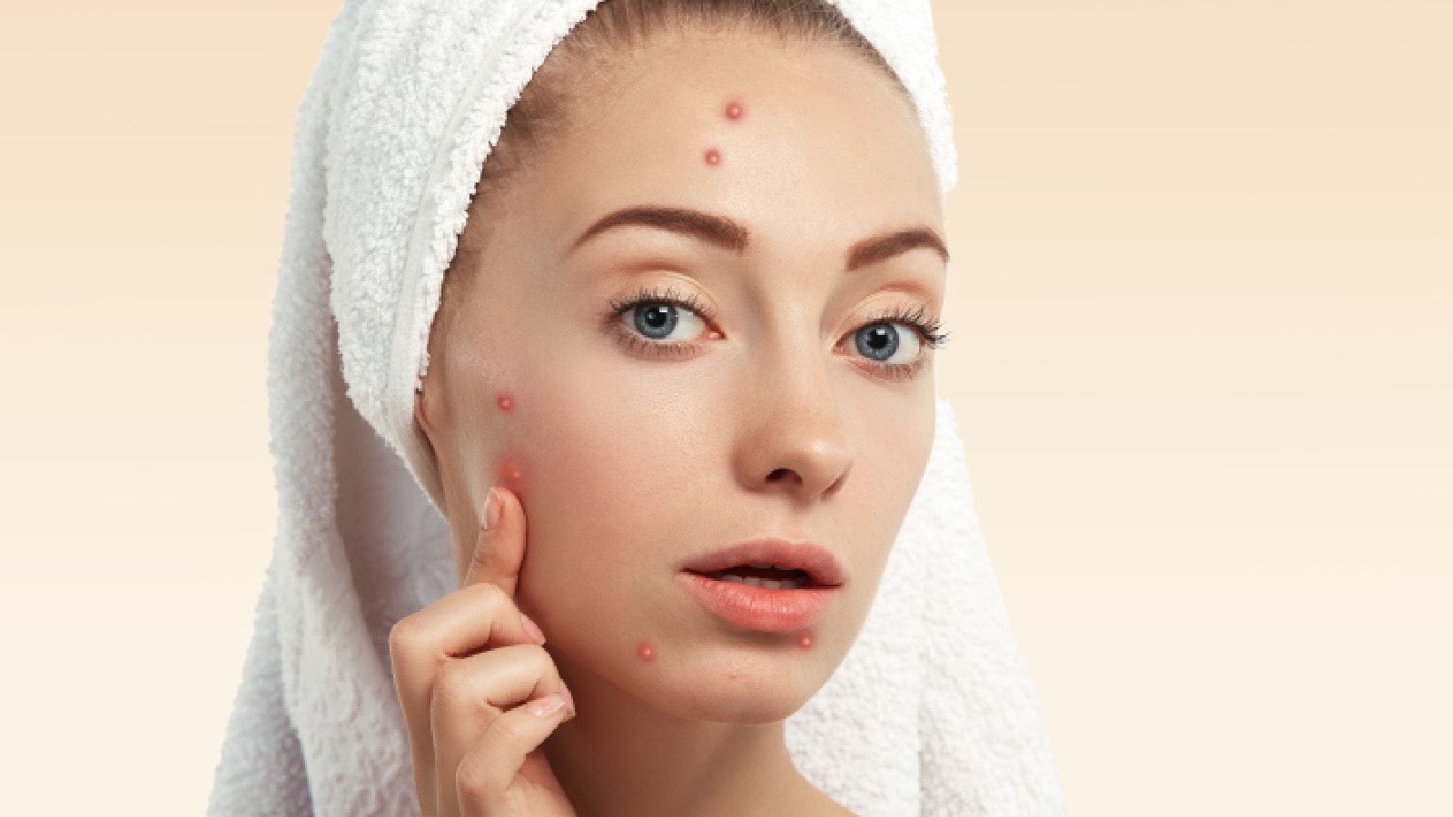 Struggling with acne? Add these 5 acne-fighting heroes to your skincare routine