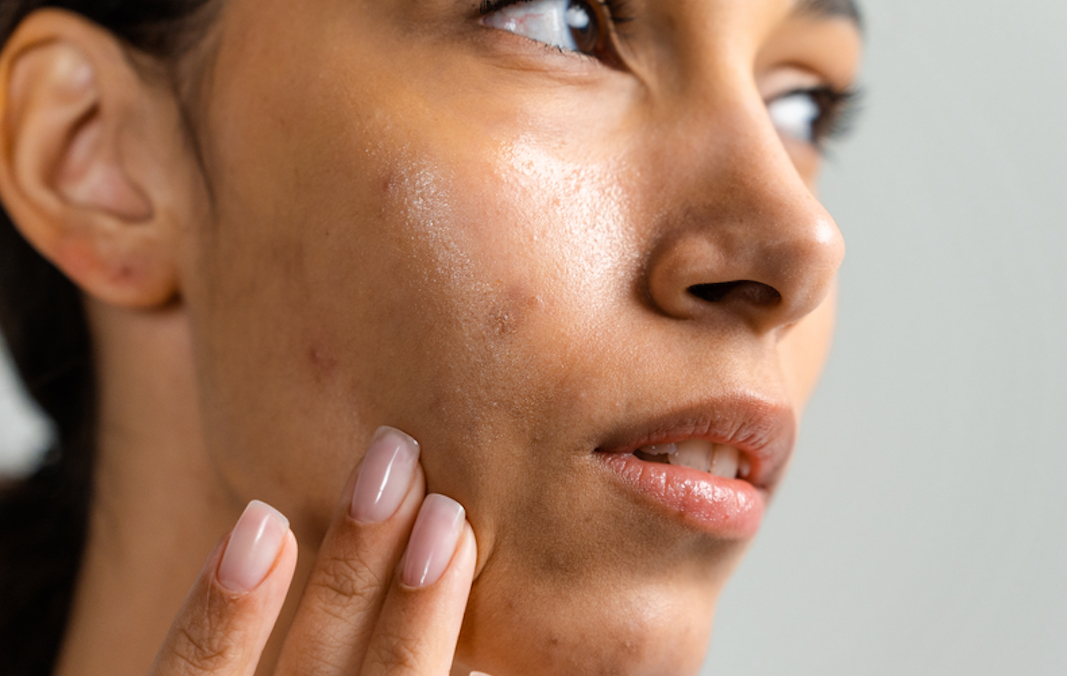 How To Remove Acne Scars Naturally? We Asked the Experts