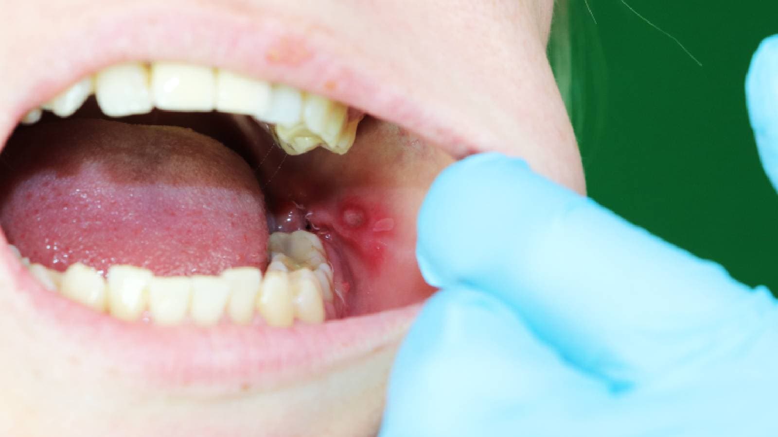 Mouth ulcers or canker sores are painful: Here’s how to treat them